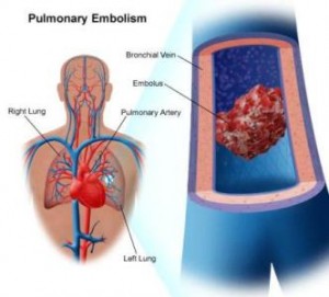 Venous Thromboembolism