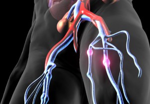 Venous Thromboembolism